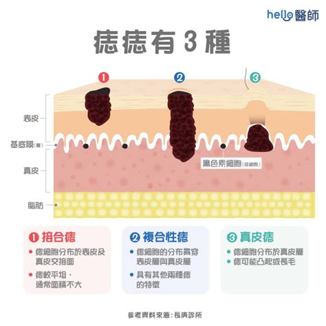 痣長毛原因|痣為什麼會長毛？了解痣與毛髮的關係與原因